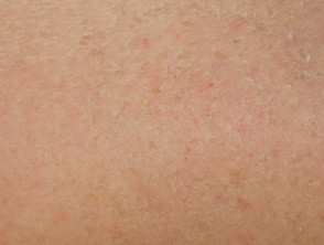 Dry skin due to vemurafenib