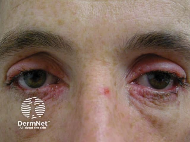 Eye involvement in erythema multiforme