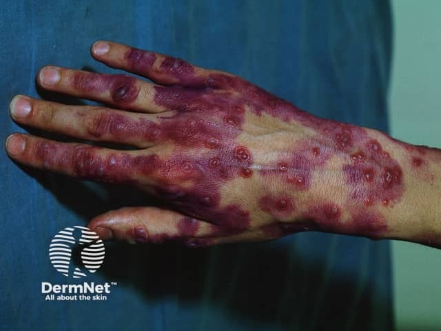 Purple stain is gentian violet