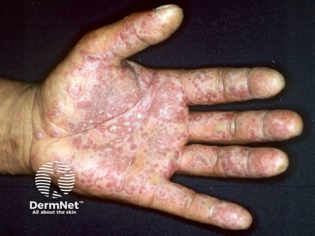 Erythema multiforme