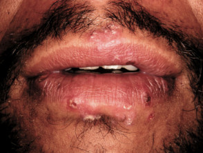 Herpes simplex labialis associated with erythema multiforme