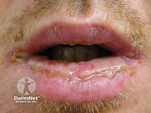 Erythema multiforme of lips