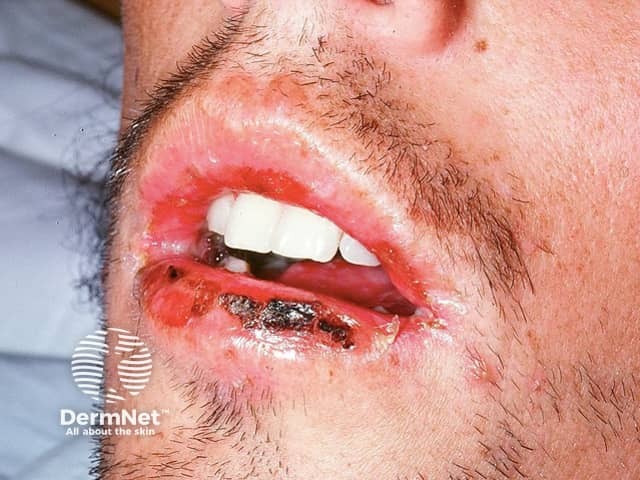 Lip involvement in erythema multiforme
