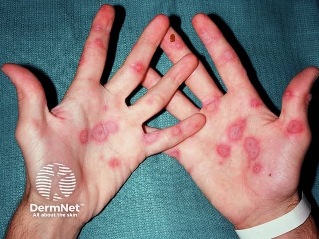 Erythema multiforme