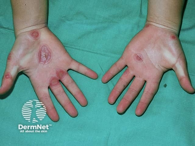 Erythema multiforme