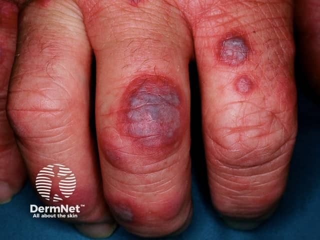 Erythema multiforme