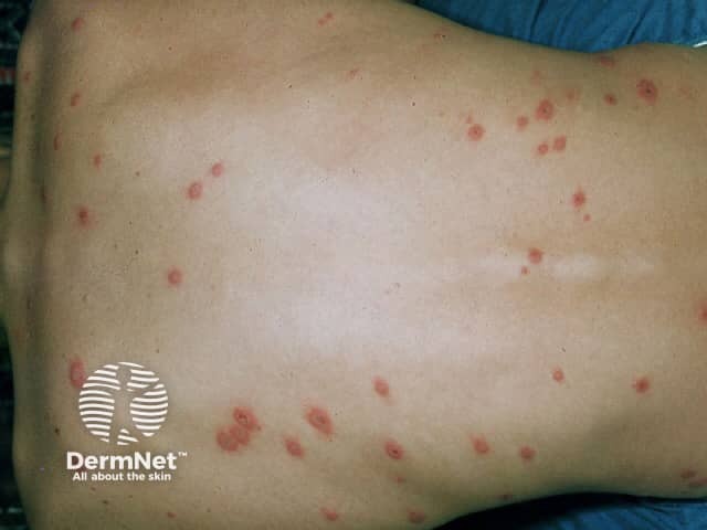Erythema multiforme