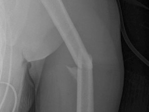 Fracture of humerus