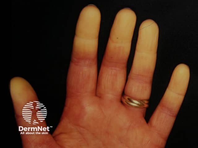 Raynaud phenomenon