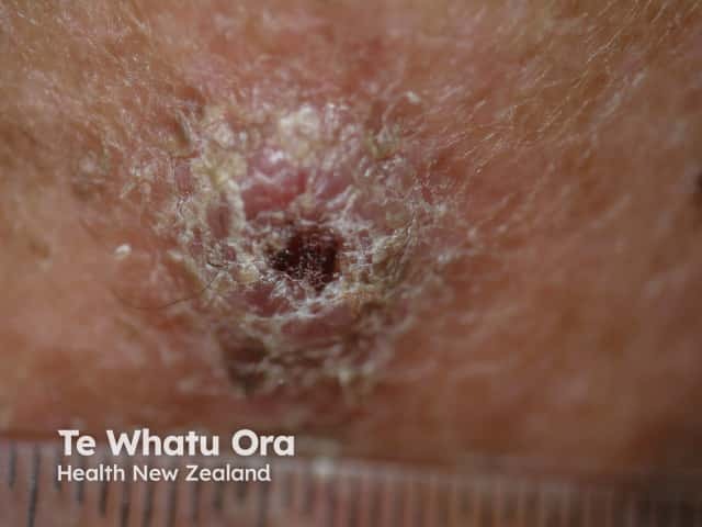 Cutaneous squamous cell carcinoma