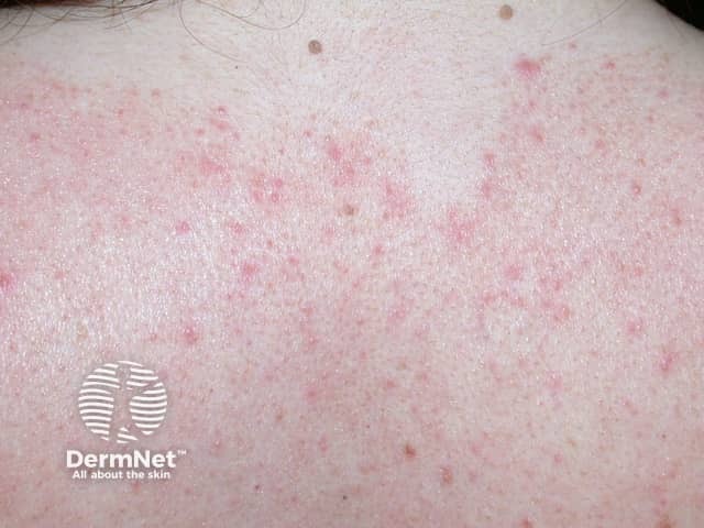 Seborrhoeic dermatitis