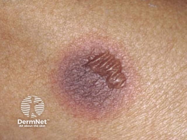 Targetoid lesion in fixed drug eruption