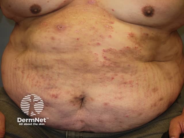 Tinea corporis