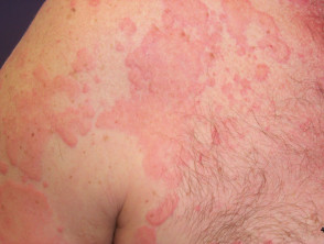 Urticaria from nonsteroidal anti-inflammatory drug
