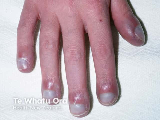 Clubbing of the nails