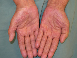 Hand-foot syndrome due to chemotherapy