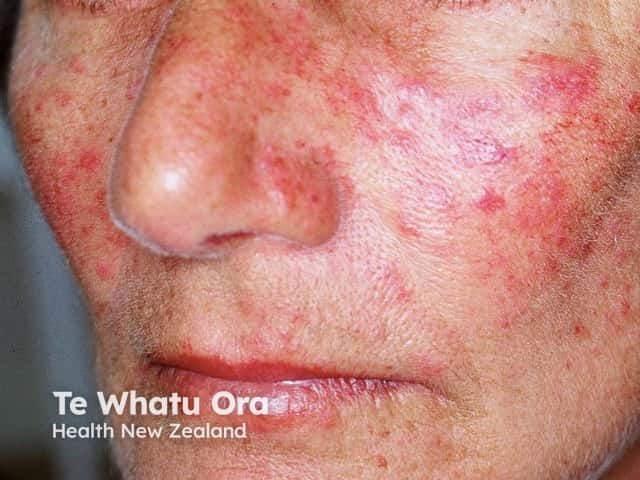 Rosacea