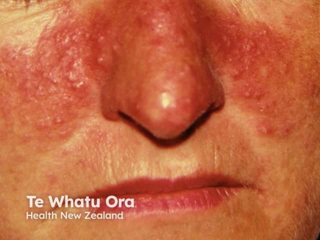 Rosacea