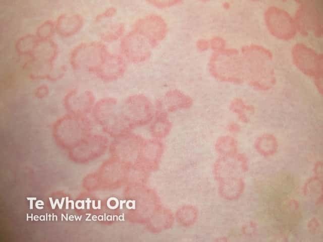 Targetoid lesions in urticaria