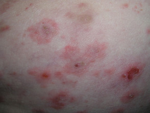 Targetoid lesion in bullous pemphigoid