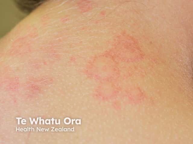 Urticaria