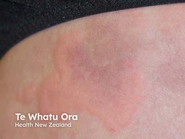 Urticaria