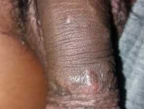 Penile papules due to scabies