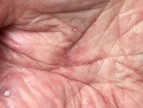 Palmar burrows due to scabies