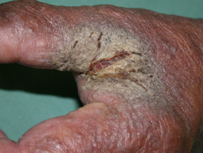 Crusted scabies