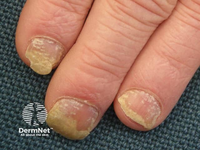 Nail Psoriasis Pictures Symptoms And Treatments