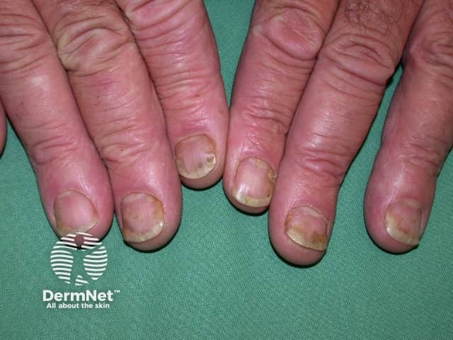 Nail Psoriasis Pictures Symptoms And Treatments