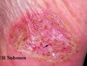 Pustular psoriasis of the hands and fee