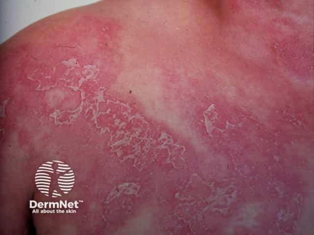 Subcorneal pustular dermatosis