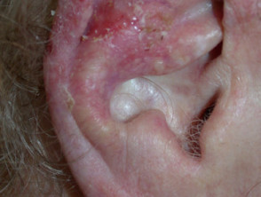 Basal cell carcinoma illdefined