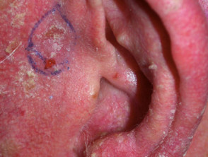Squamous basal cell carcinoma