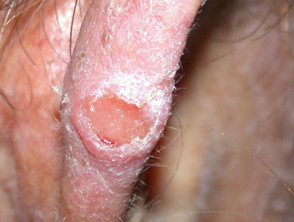 Ulcerated squamous cell carcinoma