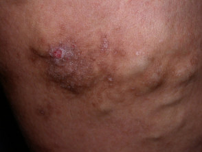 Varicose dermatitis
