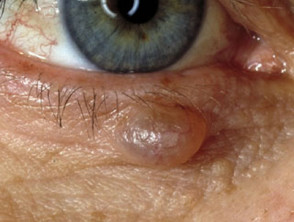 Eyelid subdoriferous cyst
