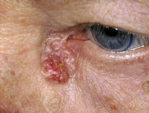 Eyelid basal cell carcinoma