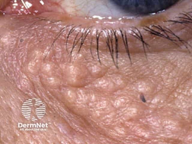 Close-up image of lid syringomas