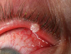 Eyelid viral wart