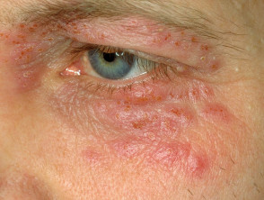 Eyelid herpes simplex