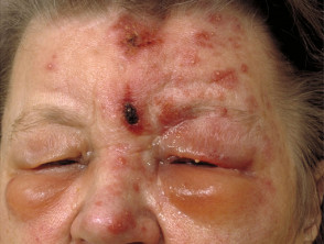 Eyelid herpes zoster ophthalmicus