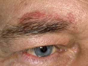 Eyebrow seborrhoeic dermatitis