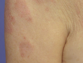 Subacute lupus erythematosus