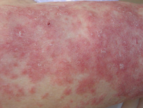 Subacute lupus erythematosus