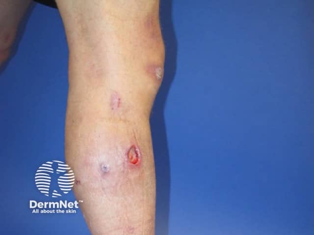 Subcutaneous Sweet disease