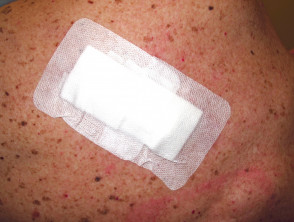 Skin surgery for melanoma