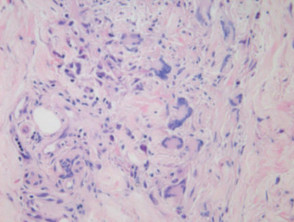 Histology of cutaneous granuloma due to Crohn disease, New Zealand Medical Journal. 2006