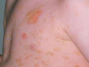 Maculopapular mastocytosis Urticaria pigmentosa